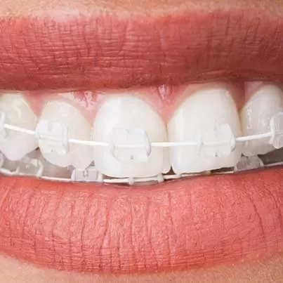 Ceramic Braces