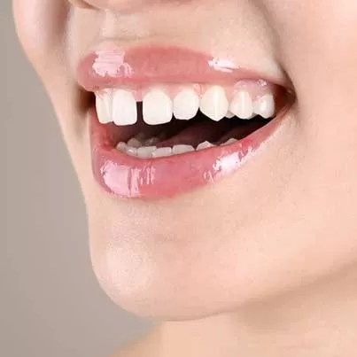Closing Teeth Gaps