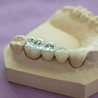 Composite Fillings