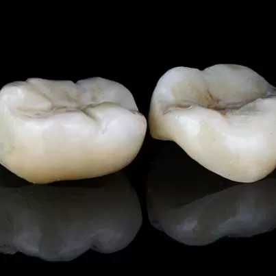 Composite Inlays and Onlays