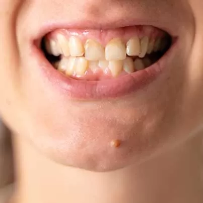 Correction of Crooked Teeth