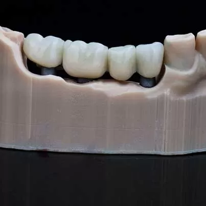 Dental Bridges