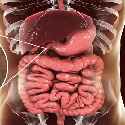 Duodenal Switch