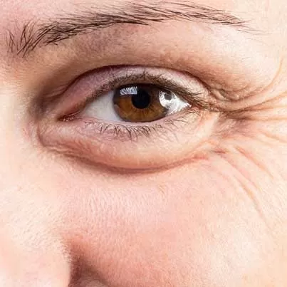 Eye Bag Removal