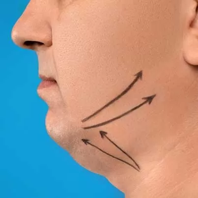 Facial Fat Injection