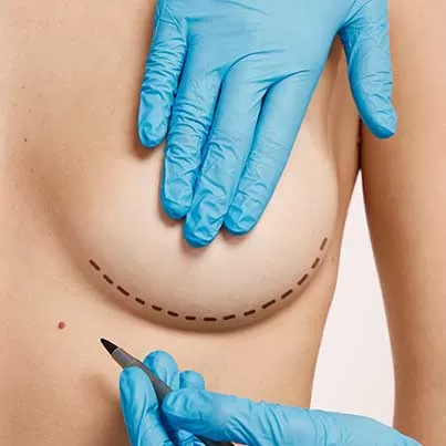 Fat Transfer Breast Augmentation