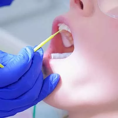 Fluoride Treatments
