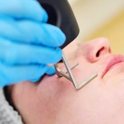 Fractional CO2 Laser