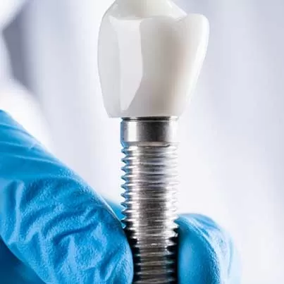 Full Mouth Implants