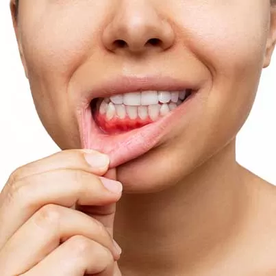 Gingivitis Treatment