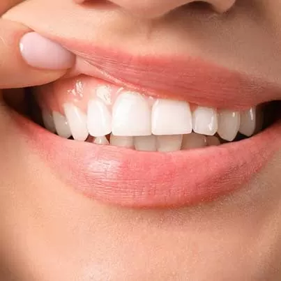 Gum Contouring