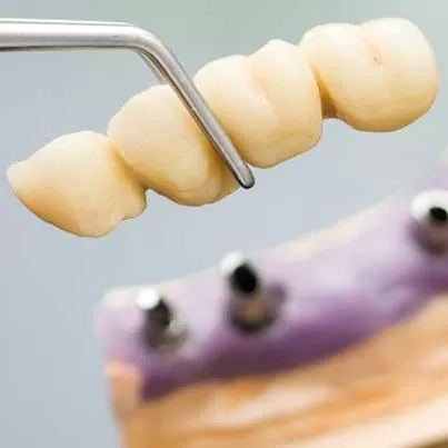 Implant-Supported Dentures