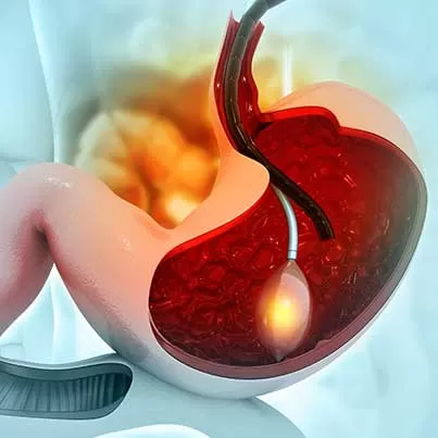 Intragastric Balloon