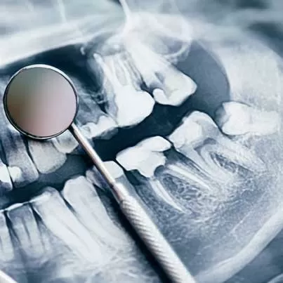 Jaw Cyst Surgery