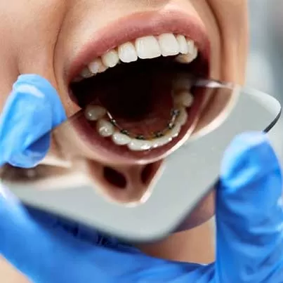 Lingual Braces