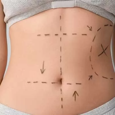Lipomatic Liposuction