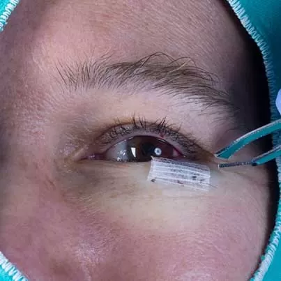 Lower Eyelid Surgery