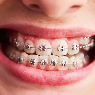 Metal Braces