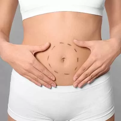 Mini Tummy Tuck