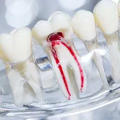 Multiple Root Canal Treatment