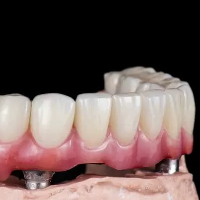 Multiple Tooth Implants