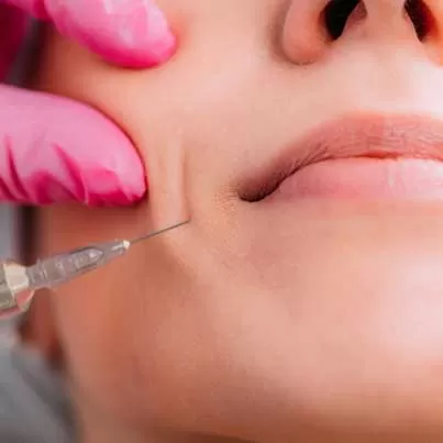Nasolabial Filler