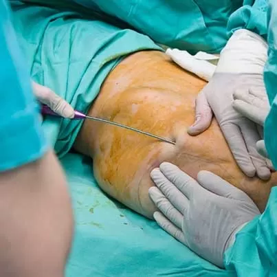 PAL (Power-Assisted Liposuction)