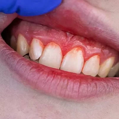 Periodontitis Treatment