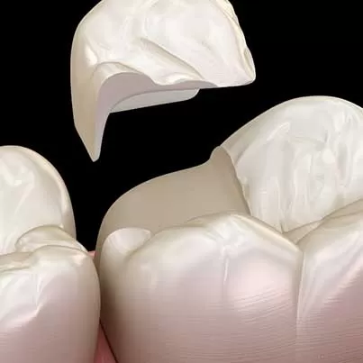 Porcelain Inlays and Onlays