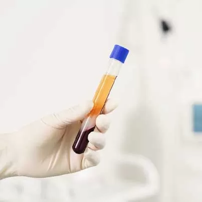 PRP (Platelet-Rich Plasma)