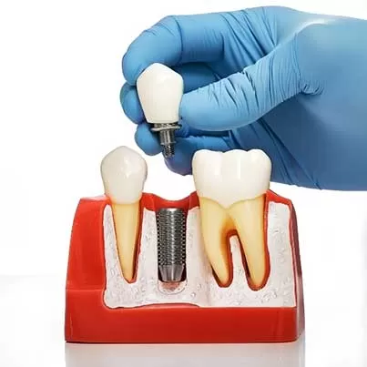 Single Tooth Implant