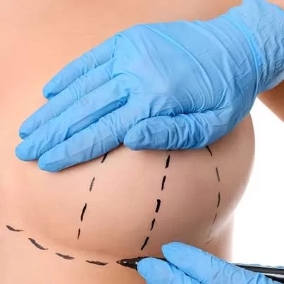 Traditional Breast Lift