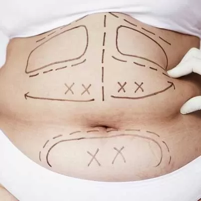 Traditional Liposuction