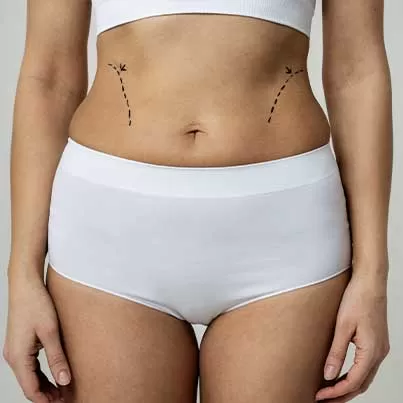 Tummy Tuck