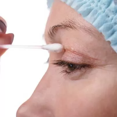 Upper Eyelid Surgery