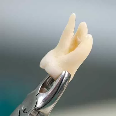 Wisdom Tooth Extraction
